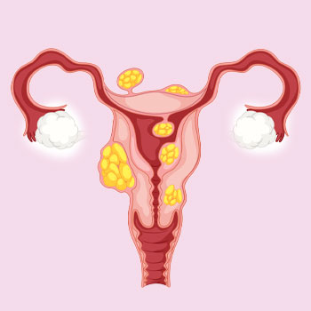 Fibroids in Guntur