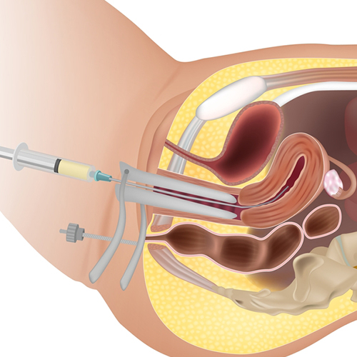 IUI Treatment in Guntur